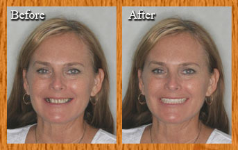 Kathy's Virtual Smile Makeover